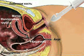 Упражнения Кегеля